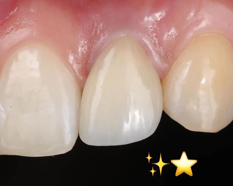 Smile Makeover — after